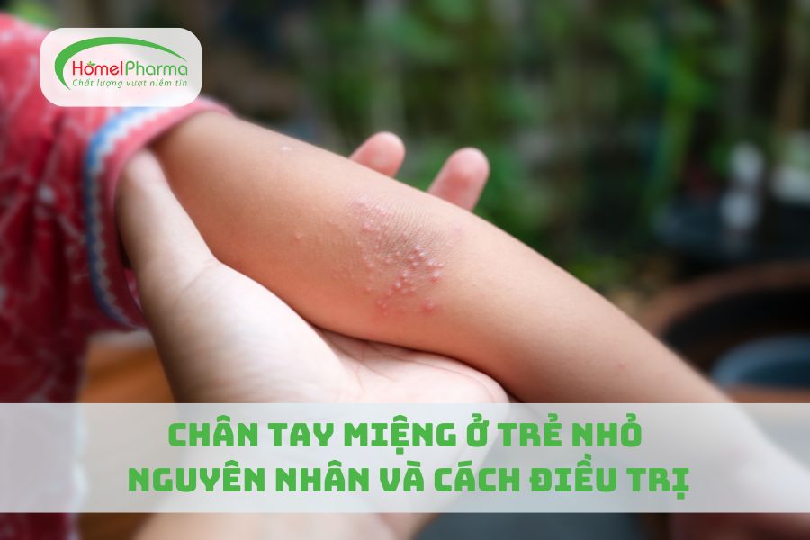 Chân Tay Miệng Ở Trẻ Nhỏ: Nguyên Nhân Và Cách Điều Trị