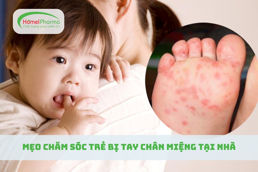 Mẹo Chăm Sóc Trẻ Bị Tay Chân Miệng Tại Nhà