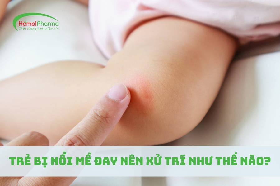 Trẻ Bị Nổi Mề Đay Nên Xử Trí Như Thế Nào?